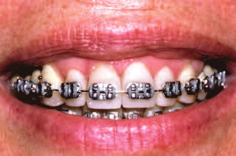 The most common reasons to place temporaries prior to orthodontics or surgery when teeth do not have existing crowns that are failing involve problems in tooth form (Kokich 2001, Vanarsdall 1989,