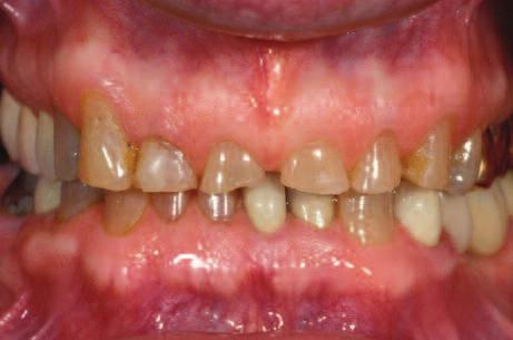 Figure 6: A patient presented with severe anterior wear and overeruption. Aesthetically, the maxillary centrals needed lengthening by 3mm incisally.
