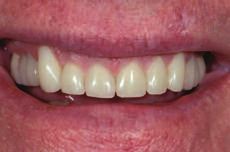 Figure 8: Osseous crown lengthening was performed using the incisal edge position of the temporary to determine bone and gingival levels.
