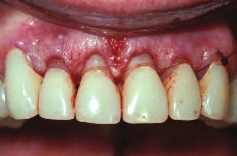 Figure 10: The final restorations demonstrate the aesthetic and functional changes from lengthening the incisal edges and raising the gingiva.