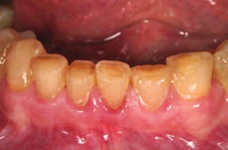 Figures 11 and 12: Orthodontics are required to intrude the mandibular anteriors and create space for their build-up.