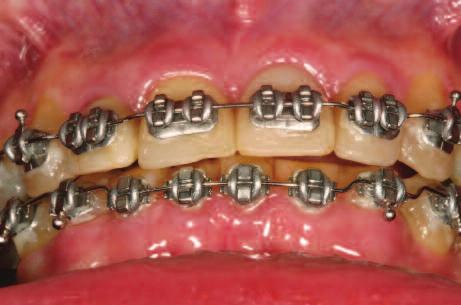 The spaces are now closed orthodontically and an ideal tooth position results. Figure 13: Brackets on the lower incisors are removed so they can be direct-bonded. because the form has been corrected.