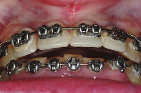 treatment much more predictable. This same concept can be applied to young patients with congenitally missing teeth (Kokich 2001) (e.g., a patient with one congenitally missing lateral incisor and the other lateral peg shaped).