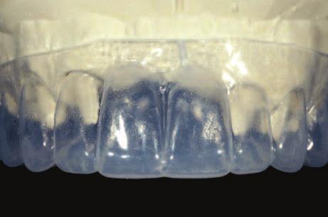 This is important because, ultimately, the goal of surgery is to position the tissue to create a pleasing tooth size relative to the correct incisal edge (Rufenache 1990, Chiche and Pinault 1994).