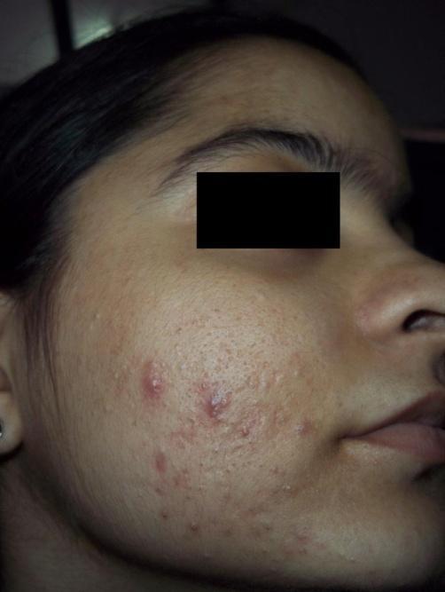 Figure 1a Acne scars along with few active lesions.