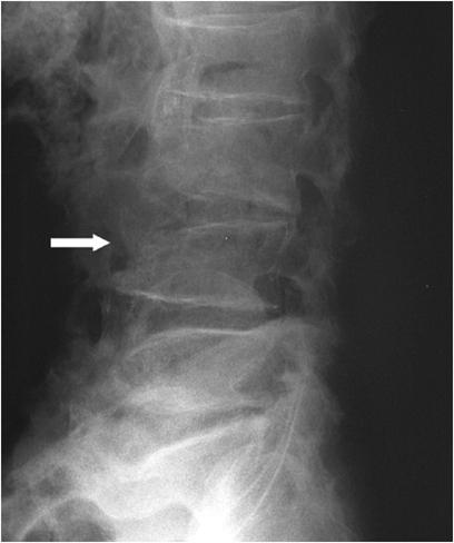 Mortality and morbidity due to vertebral fracture is also high Significant complications including back pain, height loss and kyphosis Limited activity including bending
