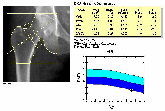 Quantitative Ultrasound (QUS ) Can only used on peripheral bones e.