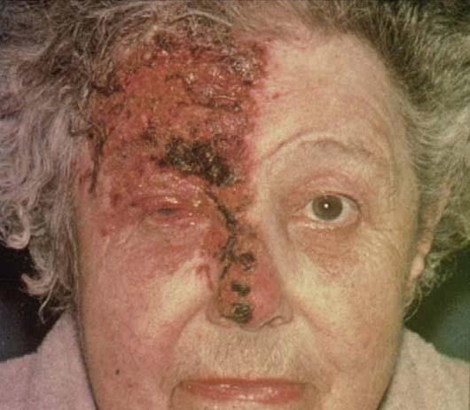 Zoster (Shingles) Reactivation of the chickenpox virus that occurs later in life Results in an