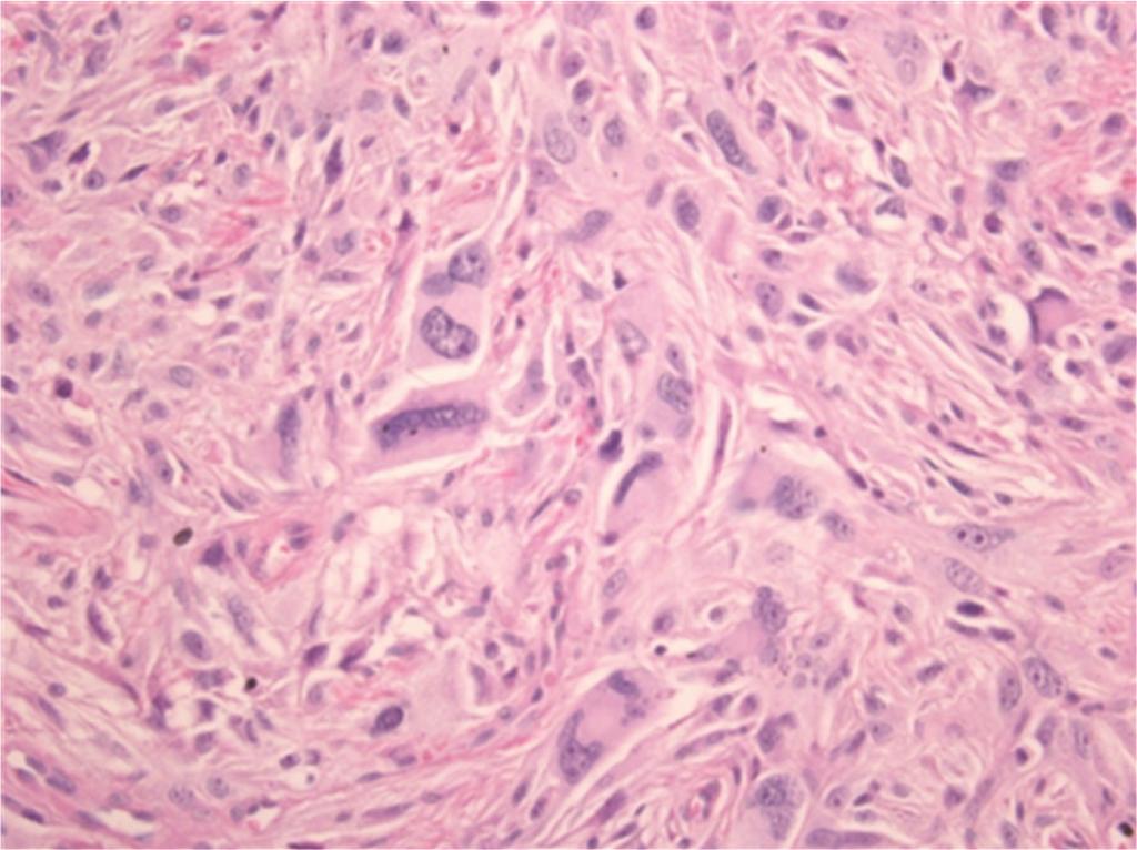 2 Figure 1: Microscopic view (400x) of the tumor of the right upper leg. The histopathological pattern, immunoprofile, and localization of this subcutaneous tumor favor the diagnosis of DFSP.
