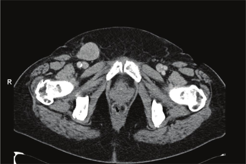 An ultrasound-guided biopsy was performed and showed a metastases of the sarcoma.