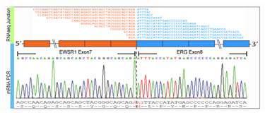 Diagnosis Use other method: RT PCR, NGS, FISH for ERG Chen S,