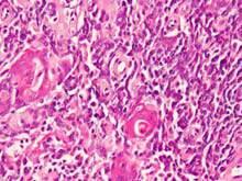 Ewing Sarcoma with Complex Epithelial