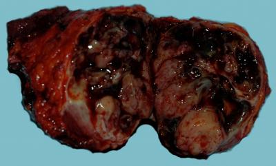 Figure 3 Figure 3: Bisected surgical specimen showing areas of fibrous white tumor admixed with hemorrhage.