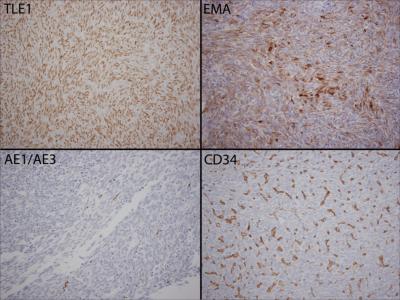 Figure 6 Figure 6: Immunohistochemical staining of the tumor for TLE1 (showing intense staining), EMA, AE1/AE3 and CD34, confirming the diagnosis of synovial sarcoma (400x).