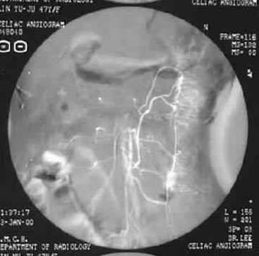 Angiography Multilpe hyperemic area