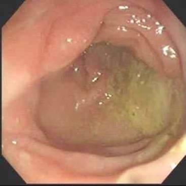 1999/12/31:coloscope Hyperemic, nodular swelling mucosa change of colon was noted at 50