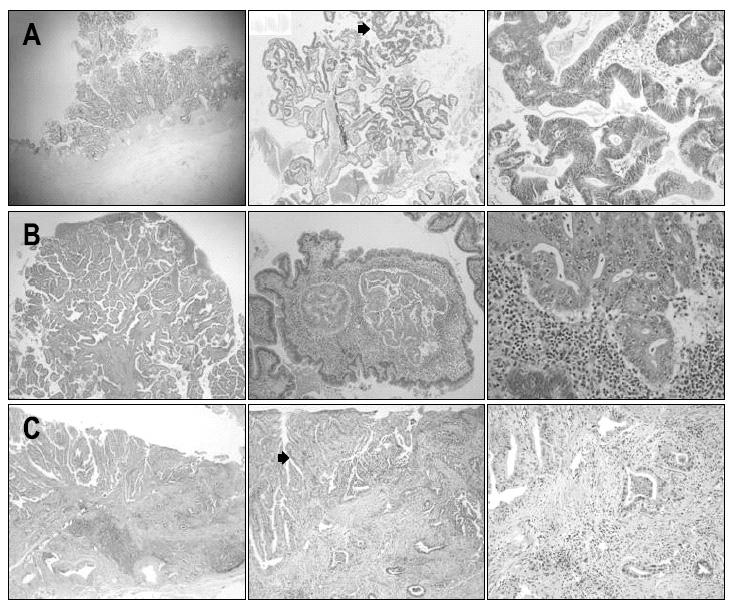제 8 회분당서울대학교병원내과연수강좌 2012 Support Adenoma-to-carcinoma progression Lee SH, et al.