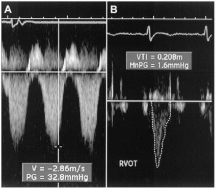 A simple method for noninvasive estimation of pulmonary vascular resistance! J Am Coll Cardiol. 2003;41(6):1021-1027. doi:10.1016/s0735-1097(02)02973-x" Figure Legend:!