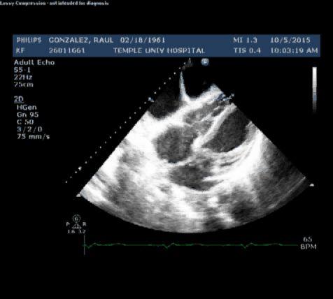 TR jet pattern in profound RV failure Doppler Role imperfections: of Echo-Doppler a