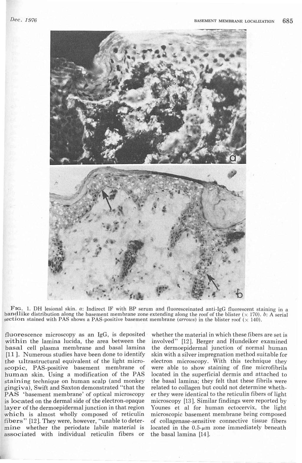 Dec. 1976 BASEMENT MEMBRANE LOCALIZATION 685 FIG. 1. DH lesional skin.