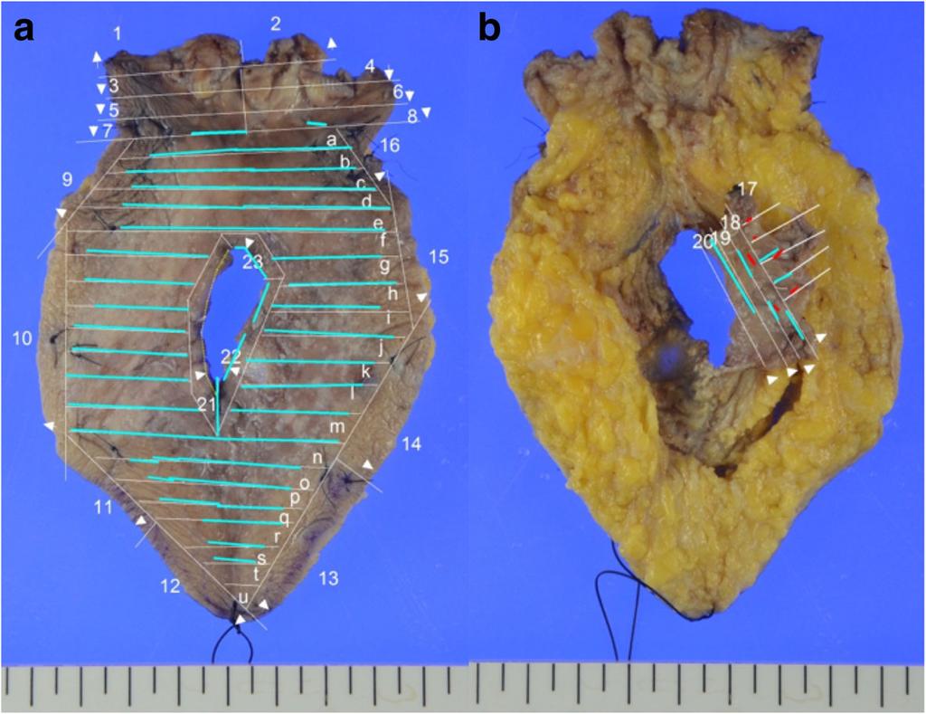 Ishioka et al. Surgical Case Reports (2018) 4:63 Page 4 of 5 Fig. 5 Macroscopic images of locally resected specimen.