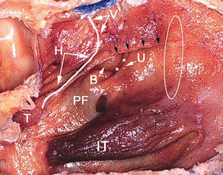 20 Zoukaa B. Sargi, Roy R. Casiano 2 Fig. 2.3. Coronal view of the olfactory clefts and fossae, in a plane transecting the ethmoid bullae.