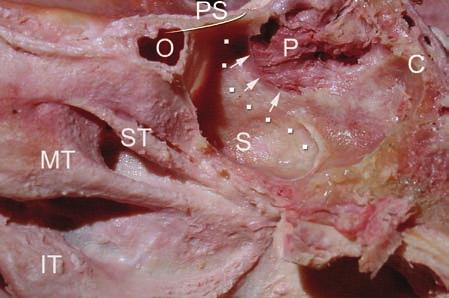 The anterior portion of the middle turbinate, missing on this view, represents its medial limit.