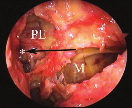 Endoscopically, most of the posterior ethmoid cavity (PE) is located superior to a line drawn at the level of the posterior orbital floor.