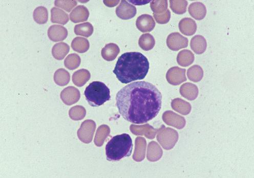 In bone marrow, low numbers of small lymphocytes and rarely seen medium and large lymphocytes are present (Fig. 1.9).