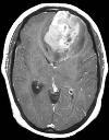 Ependymoma: Most commonly arise in children and young adults.