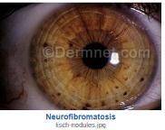 Other Manifestions of NF Type I Lisch nodules on the eye Melanocytic hemartomas Café-au-lait spots on skin Discolored birth marks 61 Medscape Source: