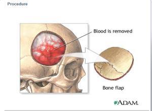 Craniotomy Procedure A section of the skull, (called a bone flap) is removed to access the brain