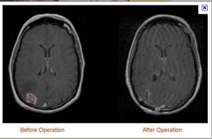 Pre- and Post-Operative Imaging Pre-op tumor is outlined in red Post-operative MRI shows complete