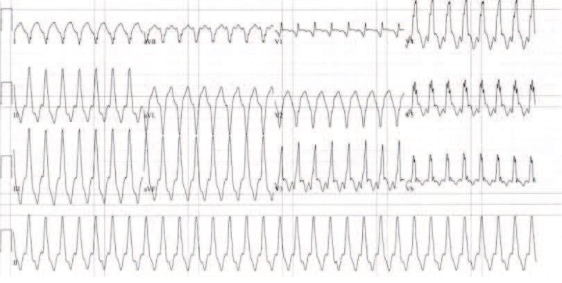 10 Interpreting Cardiac Electrograms - From Skin to Endocardium Figure 9. SVT with aberrancy. Figure 10.
