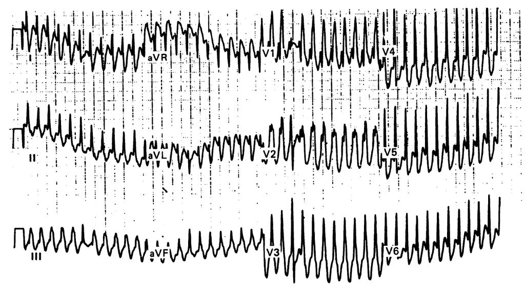 Fusion or Capture beat during tachycardia: SVT: AP +
