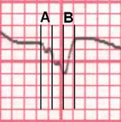 The avr and Vi/Vt Vereckei Algorythm: The avr lead should always present negative vector in normal condition.