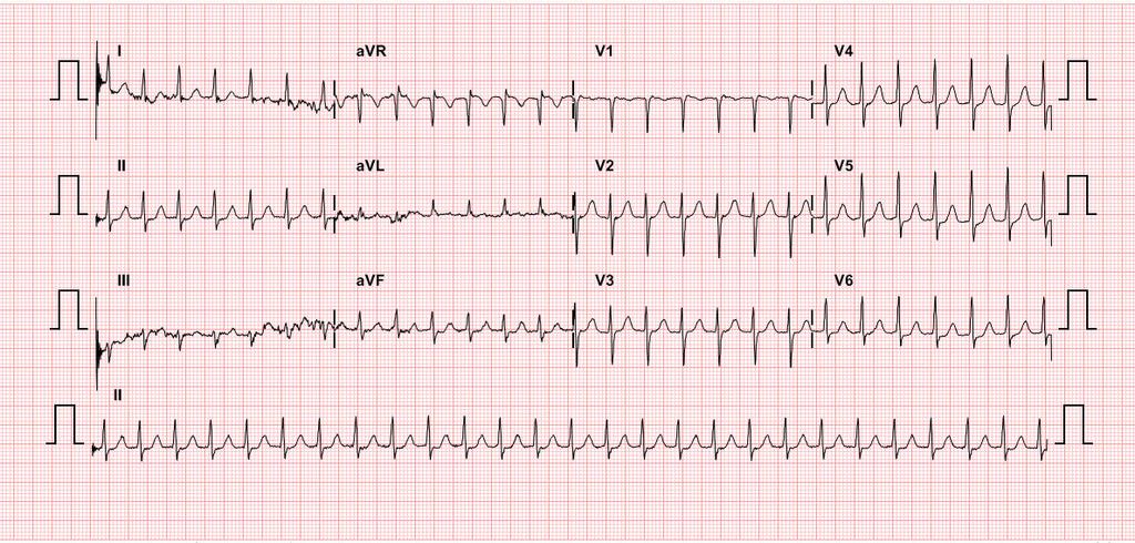 Short RP narrow QRS tachycardia: Absence of P-wave. 1.