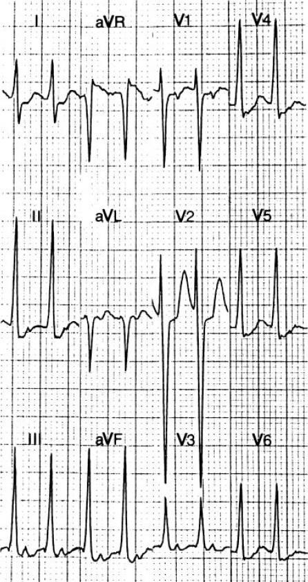 Short RP narrow QRS tachycardia: When absence of pseudo s-wave or pseuro r-wave, II,