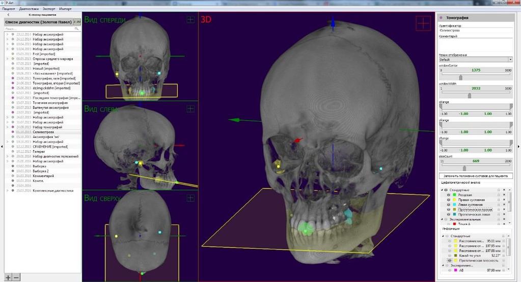 Dentograf. Connection with CBCT. X-ray and computed tomography gives additional information about the patient.