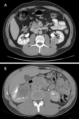 ADAMY ET AL. FIG. 1. Images from a 48-year-old male with an incidental diagnosis of a left renal mass.