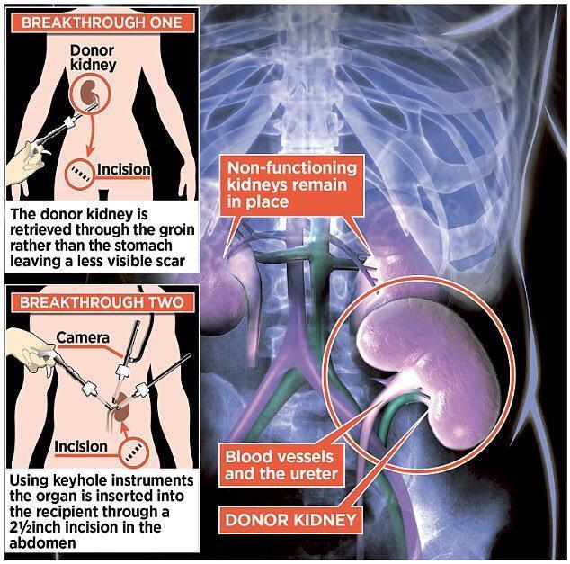Kidney Transplantation This mode of renal replacement therapy has