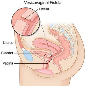 If you have a fistula, urine will leak from the vagina, and since the vagina is not designed to hold urine you will not be able to control this. How does a fistula develop?