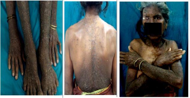 Fig. 1: Warty, yellowish brown papules over upper and lower limbs. Fig. 2: Warty yellowish brown papules over back.