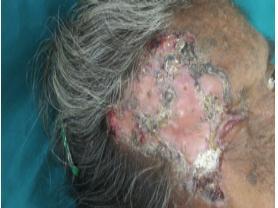 8) Biopsy from warty papule shows characteristic suprabasal acantholysis and dyskeratosis seen in DD. Fig. 9 Fig.