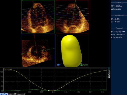 3D echocardiography Jacobs LD