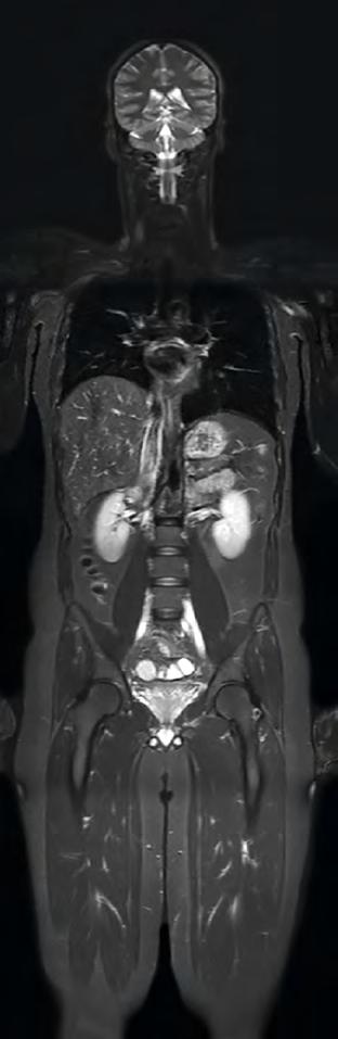 Note that the splenic lesions are veiled by the high physiological background diffusion signal in splenic tissue.