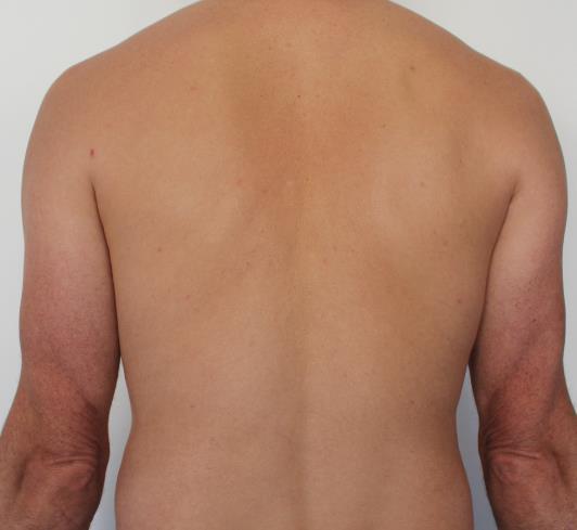 Bladder Channel Case Study Male back (Godson, 2015) A 40 year old man presents with muscle pain due digging in the garden for two days. What would your 8 principle pattern diagnosis be?