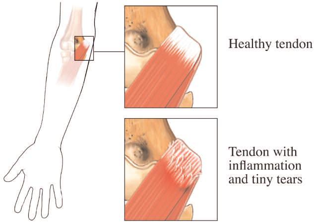 What is Tennis Elbow? Tennis elbow is the common name for an injury to the muscles and tendons on the outside (lateral aspect) of the elbow that results from overuse or repetitive stress.