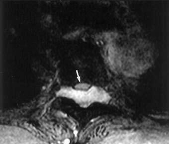 128 MRI of spinal epidural hemangioma formed. During surgery, the epidural mass appeared to be a soft, elastic and easily bled tumor.
