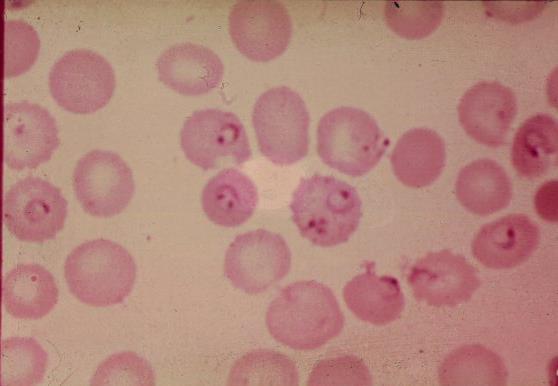 Problem Co-existence of two species of the Plasmodium genus in a single host (mixed-species infection) has disrupted the diagnosis and treatment of malaria.